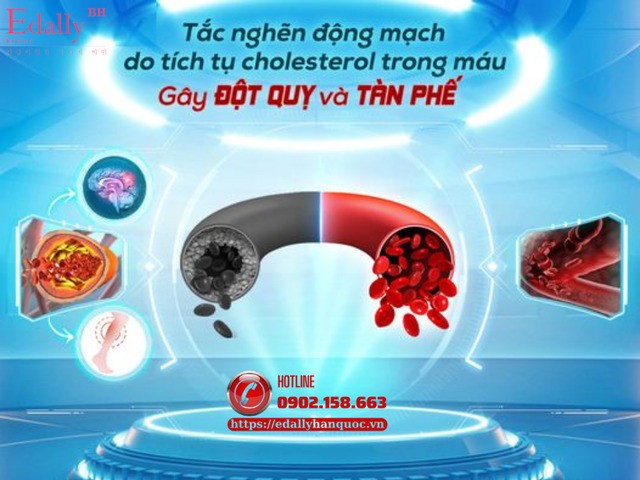 Mỡ máu và mảng xơ vữa mạch máu do tích tụ cholesterol là nguyên nhân hàng đầu gây đột quỵ và nhồi máu cơ tim