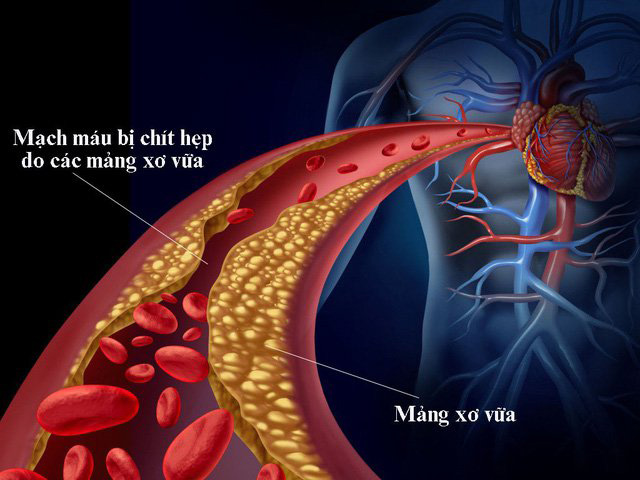 Mỡ máu cao là nguyên nhân chính gây nên xơ vữa động mạch