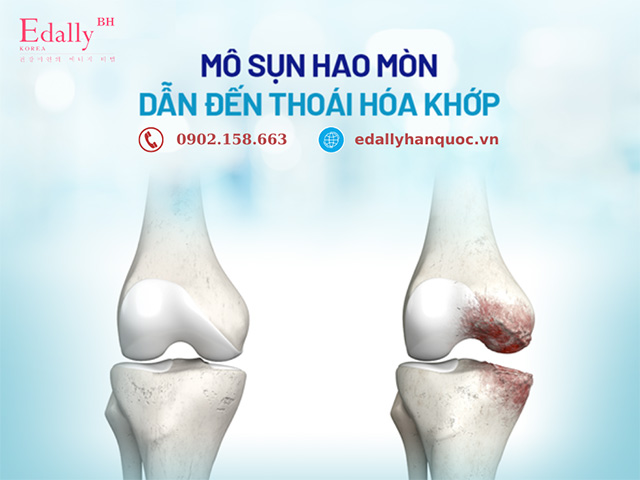 Mô sụn hao mòn dẫn đến thoái hóa khớp