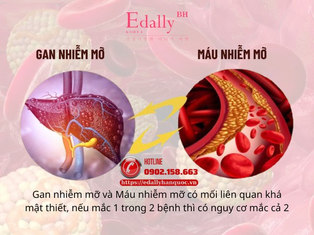 Gan nhiễm mỡ và Máu nhiễm mỡ có mối liên quan khá mật thiết, nếu mắc 1 trong 2 bệnh thì có nguy cơ mắc cả 2
