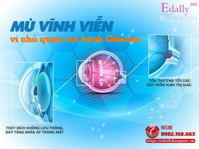 Đừng để mù vình viễn vì chủ quan với bệnh Glôcôm