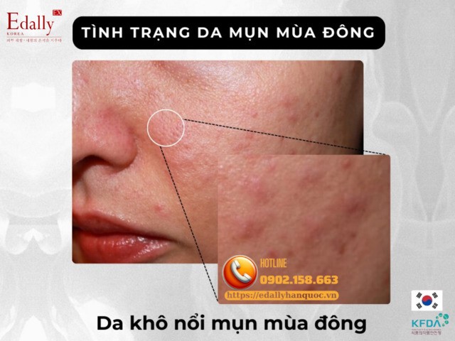 Mùa đông và nỗi ám ảnh làn da mụn