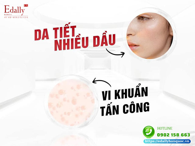 Mùa hè da dễ nổi mụn là do da tiết dầu nhiều