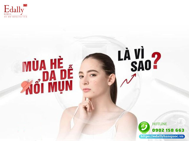 Mùa hè da dễ nổi mụn là vì sao?