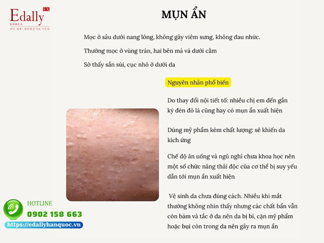 Mụn ẩn là gì?