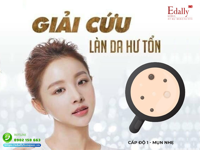 Cách nhận biết Mụn cấp độ 1 - Mụn nhẹ