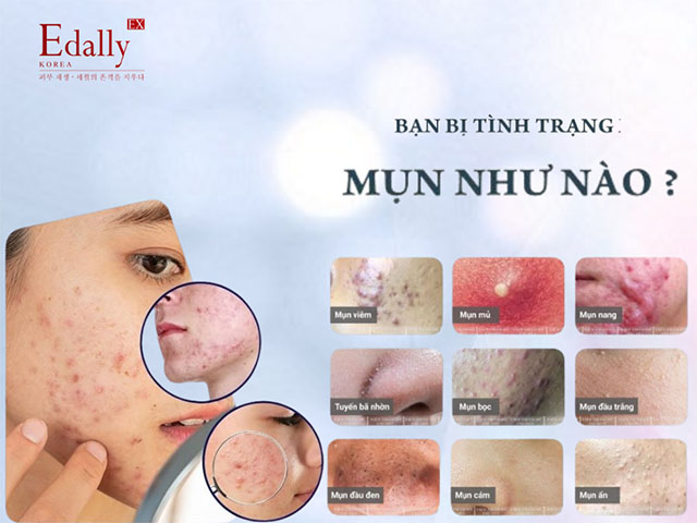 Mụn Thì Có Những Loại Nào?