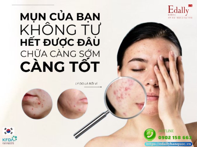 Mụn của bạn không tự hết được đâu, hãy chữa càng sớm càng tốt