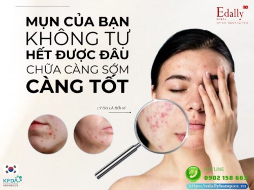 Mụn Của Bạn Không Tự Hết Được Đâu, Chữa Càng Sớm Càng Tốt