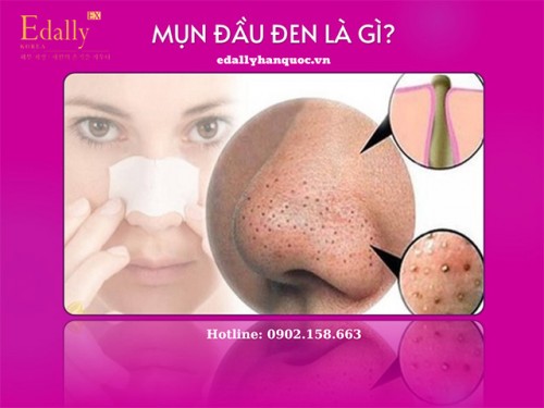 Mụn Đầu Đen Là Gì? Cách Skincare Trị Mụn Đầu Đen?