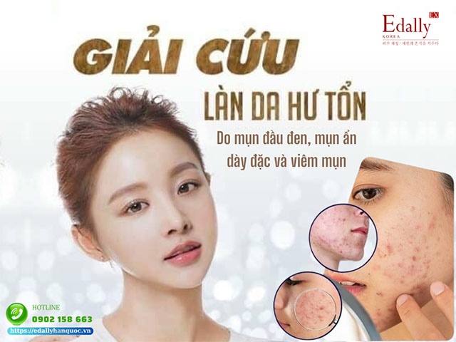 Mụn đầu đen, mụn ẩn xuất hiện tình trạng dày hơn và có dấu hiệu viêm mụn thì nên chăm sóc da như thế nào để cải thiện?