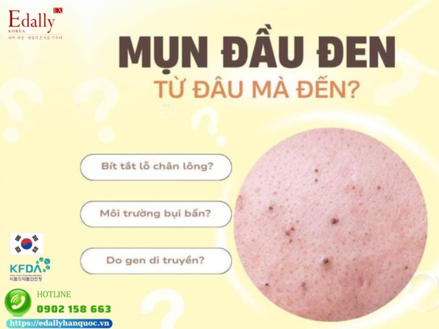 Tại sao chúng ta lại bị mụn đầu đen?