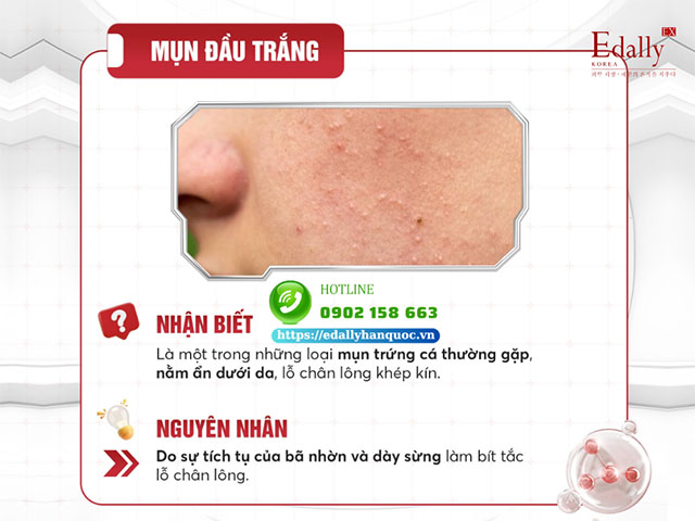 Cách nhận biết mụn trứng cá đầu trắng