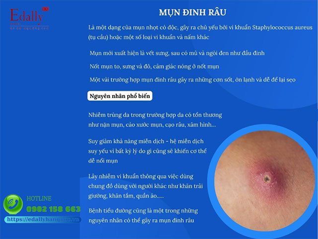 Mụn đinh râu là gì?