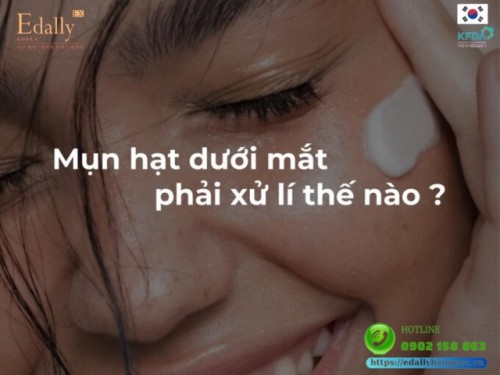 Mụn Hạt Kê (Hạt Milia) Dưới Mắt Điều Trị Như Thế Nào?