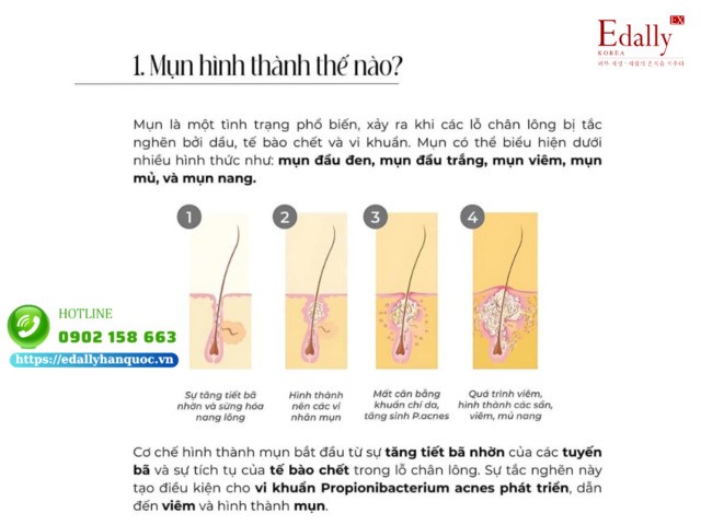 Mụn được hình thành thế nào?