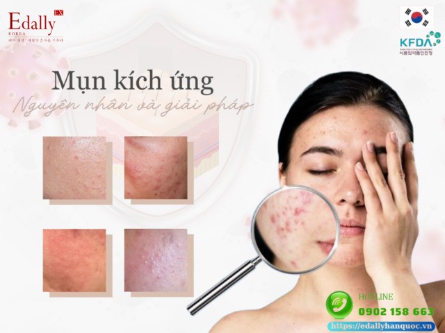 Mụn kích ứng - Nguyên nhân và giải pháp điều trị hiệu quả