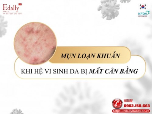 Mụn Loạn Khuẩn: Khi Hệ Vi Sinh Trên Da Bị Mất Cân Bằng