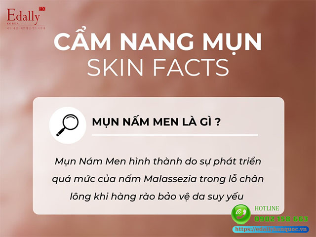 Mụn nấm men là gì?