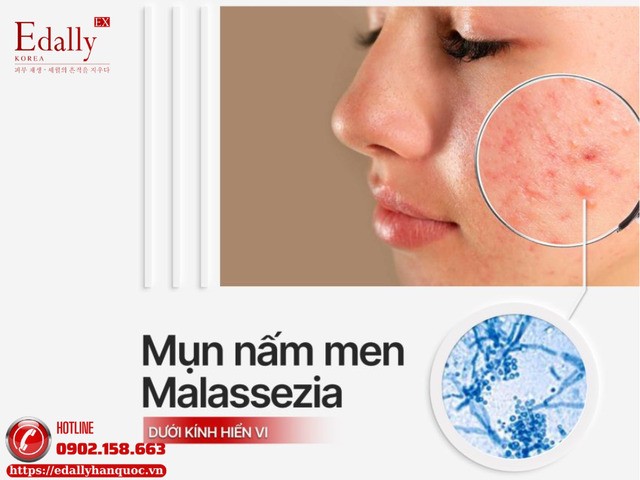 Mụn nấm men (Malassezia) dưới kính hiển vi