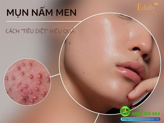 Mụn nấm men - Nguyên nhân, triệu chứng và cách điều trị hiệu quả tại nhà