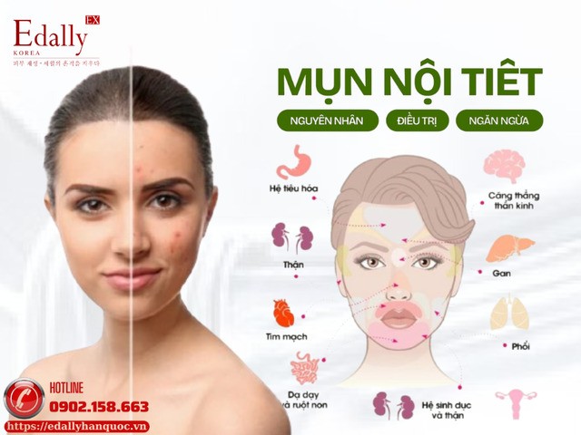 Mụn nội tiết (Hormonal acne): Nguyên nhân, đặc điểm và cách điều trị hiệu quả