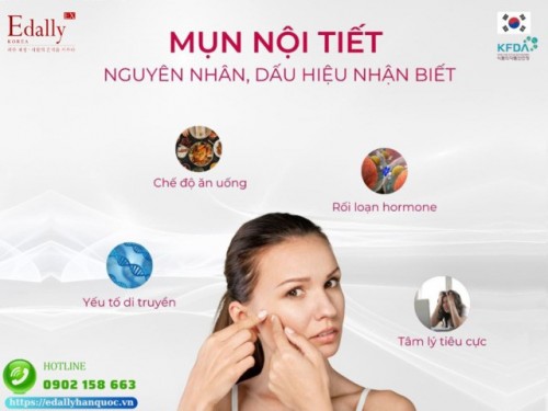 Bị Mụn Nội Tiết Cần Phải Hiểu Những Điều Sau