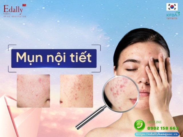 Những điều bạn cần biết về mụn nội tiết để chăm sóc và điều trị hiệu quả