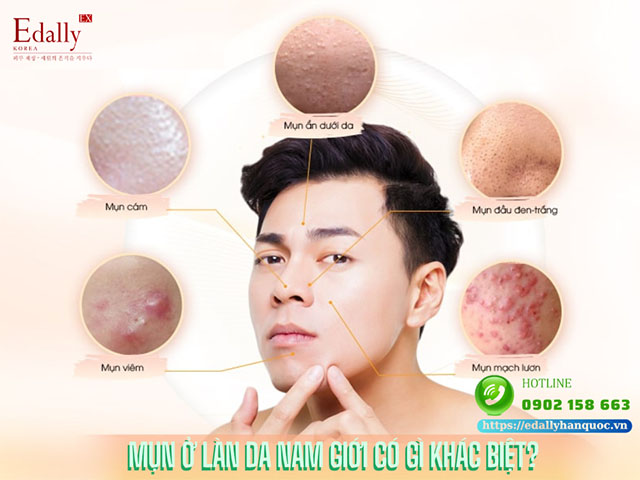 Mụn Ở Làn Da Nam Giới Có Gì Khác Biệt?