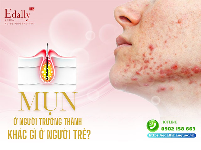 Viêm mụn ở người trưởng thành thì các đặc điểm này có gì khác so với tuổi trẻ?