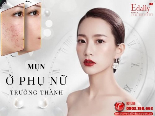 Mụn Ở Phụ Nữ Trưởng Thành: Nguyên Nhân Và Dấu Hiệu Nhận Biết