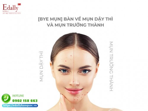 Mụn Tuổi Dậy Thì Và Mụn Ở Người Trưởng Thành