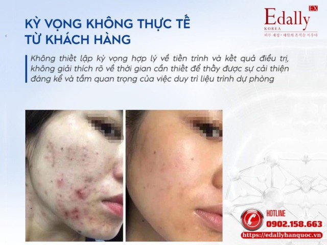 Mụn tái đi tái lại nhiều lần là do kỳ vọng không thực tế từ phía khách hàng