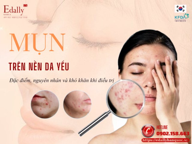 Mụn trên nền da yếu - Đặc điểm, nguyên nhân và cách điều trị