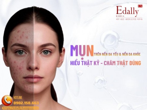 Mụn Trên Nền Da Yếu Và Mụn Trên Nền Da Khỏe - Hiểu Thật Kỹ, Chăm Thật Đúng