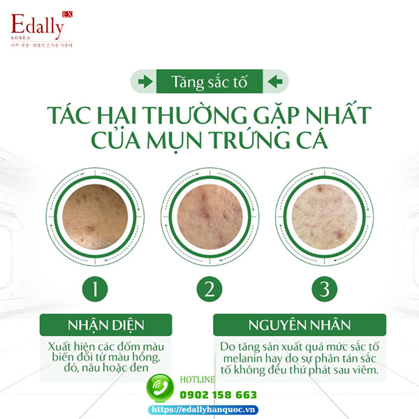 Hậu quả thường gặp nhất của mụn trứng cá là tăng sắc tố da