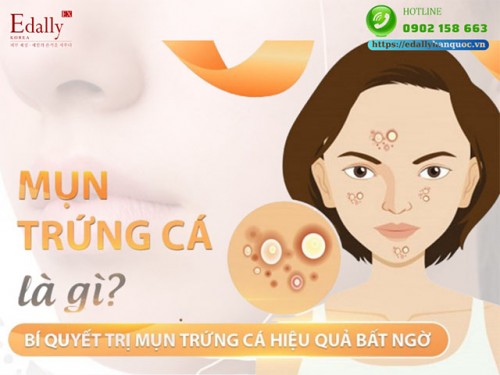 Mụn Trứng Cá - Phân Loại Để Dễ Dàng Đánh Bại