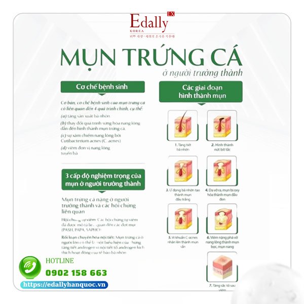 Mụn trứng cá ở người trưởng thành