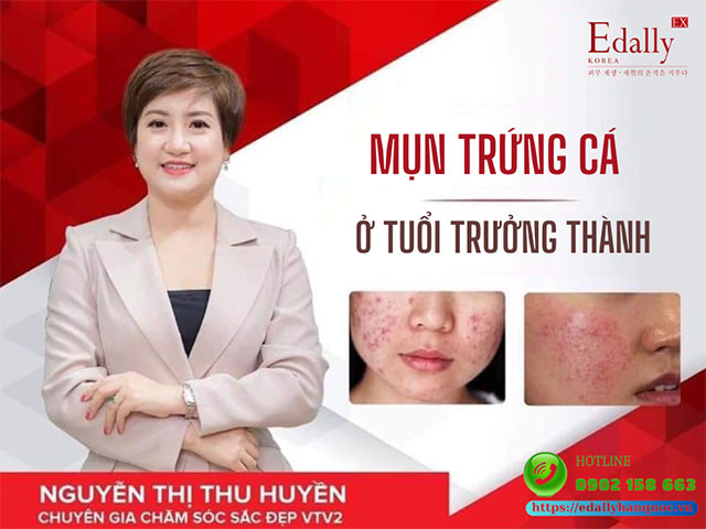 Những cập nhật mới về Mụn trứng cá ở người trưởng thành