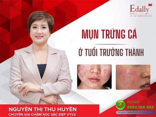 Mụn Trứng Cá Ở Người Trưởng Thành Và Cách Điều Trị