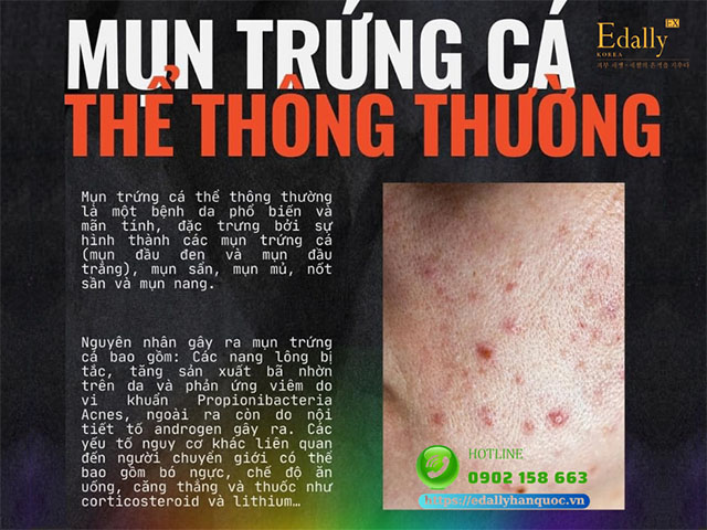 Mụn trứng cá thể thông thường là bệnh da thường gặp ở người chuyển giới