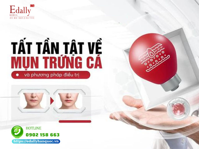 Tất tần tật về mụn trứng cá và cách điều trị hiệu quả tại nhà