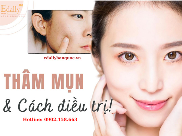 Cách điều trị mụn và thâm mụn như thế nào?