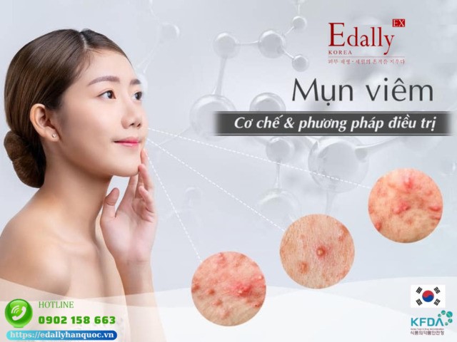 Mụn viêm - Cơ chế và cách điều trị hiệu quả nhất hiện nay