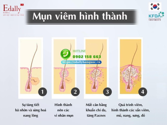 Mụn viêm được hình thành như thế nào?