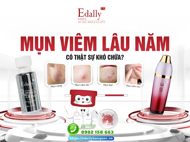 Mụn viêm lâu năm có thực sự khó chữa không?