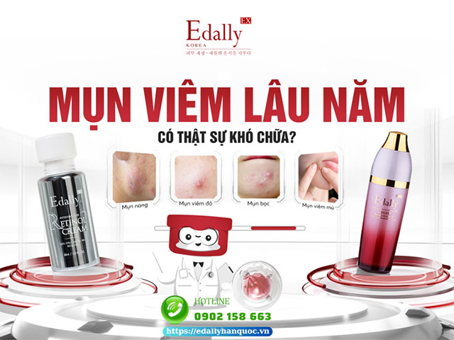 Mụn Viêm Lâu Năm Có Thực Sự Khó Chữa?