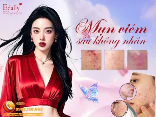 Mụn Viêm Sâu Không Nhân: Nguyên Nhân, Triệu Chứng Và Cách Điều Trị Hiệu Quả
