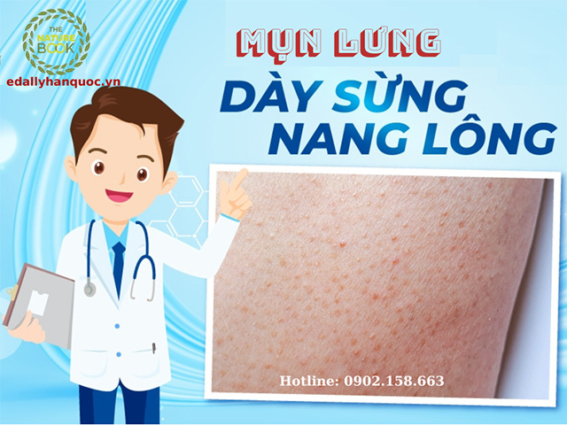 Mụn lưng, dày sừng và viêm nang lông