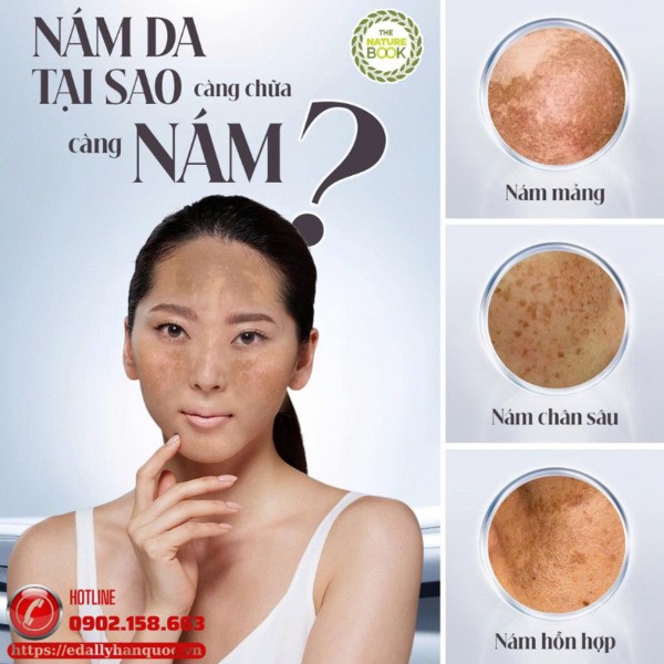 Nám da - Tại sao càng chữa càng nám nhiều hơn? Nám da - Tại sao càng chữa càng nám nhiều hơn?